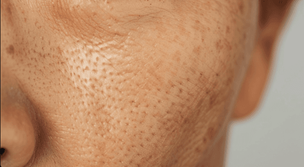 밴쿠버 스마일웰메디컬스파 모공 축소 시술