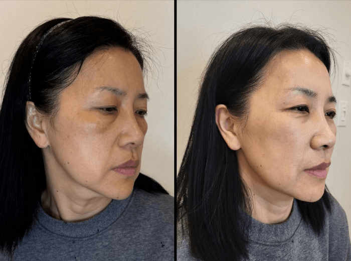 Melasma treatment before and after results at Smile Well Coquitlam
