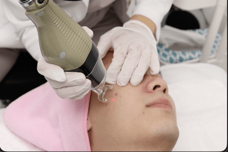 Acne scar treatment at Smile Well Coquitlam