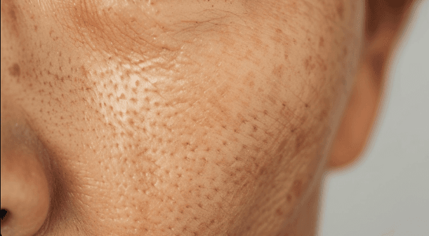 Large pores minimizing treatment at Smile Well Coquitlam